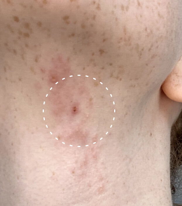 Image of a person with eczema on their neck